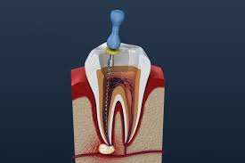 BEST ROOT CANAL TREATMENT